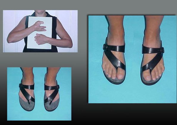 Partial external cosmetic prosthesis / foot Therapeutic PHP aesthetic prostheses