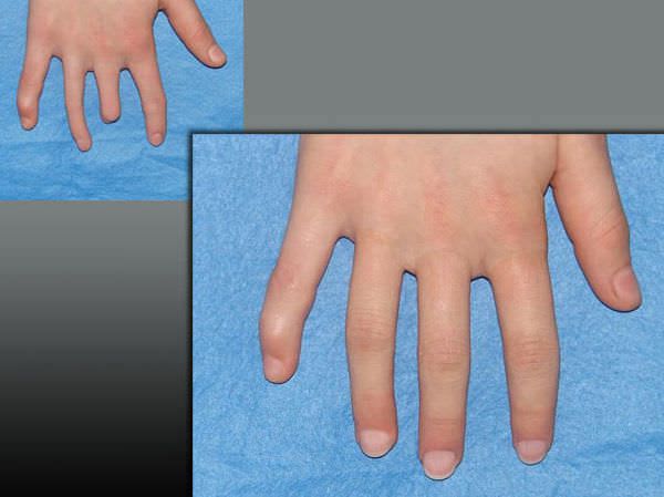 Finger external cosmetic prosthesis Multiple PHP aesthetic prostheses