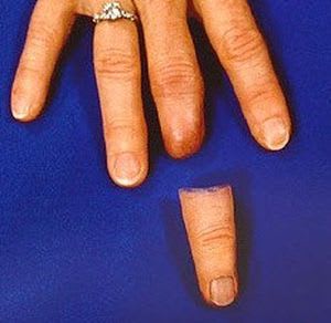 Finger external cosmetic prosthesis RealLifeSkin™ RealLifeSkin