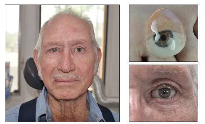 Eye external cosmetic prosthesis RealLifeEye™ RealLifeSkin