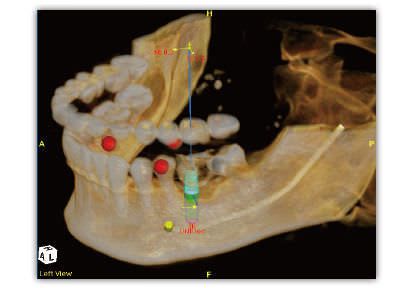 Planning software / for dental implant simulation / for implantology / dentist office ImplantMax Saturn Imaging Inc.