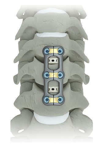 Cervical arthrodesis plate / anterior / 2 levels TRESTLE LUXE® Alphatec Spine