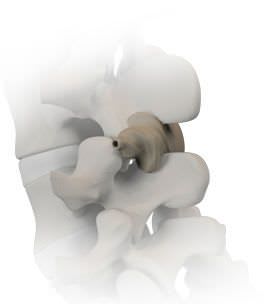 Interspinous vertebral implant HELIFIX® Alphatec Spine