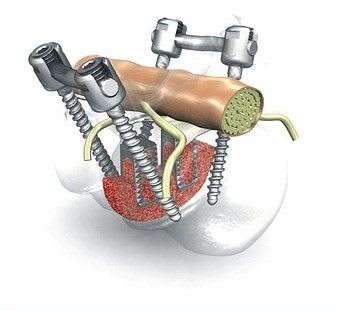Thoraco-lumbo-sacral spinal osteosynthesis unit / posterior WSI MX/PX-Titan® Expertise Peter Brehm