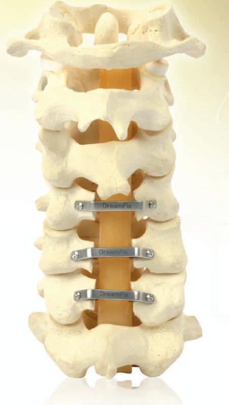 Cervico-thoracic spinal osteosynthesis unit / posterior DREAMFIX Dream