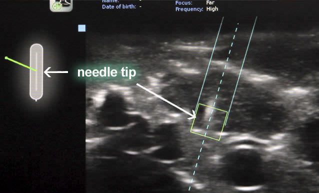 Navigation software / viewing / medical / for ultrasound imaging eZGuide™ eZono