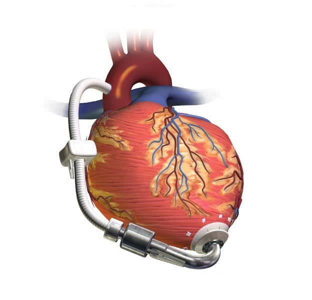 Ventricular assist device HEARTASSIST 5® Micromed Cardiovascular