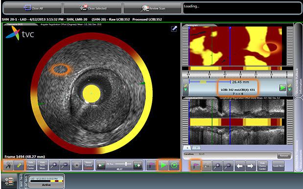 Intravascular imaging system TVC Composite™ Image Infraredx