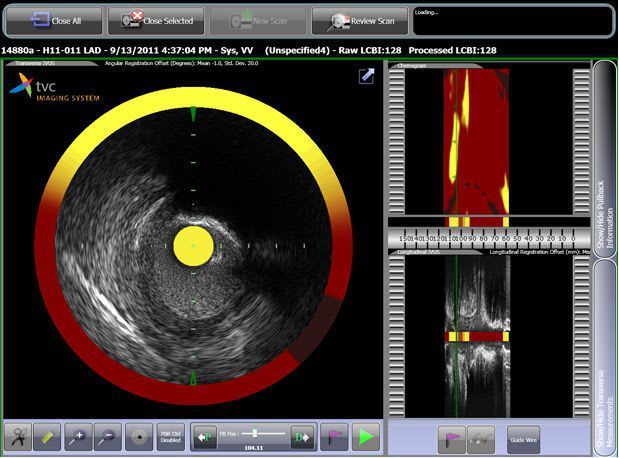 Ultrasound system / on platform / for intravascular ultrasound imaging TVC Imaging System™ Infraredx