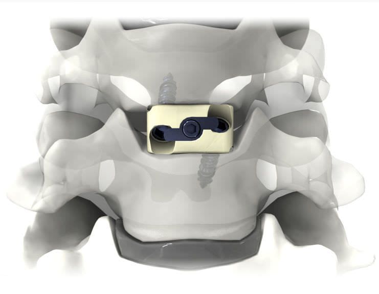 Cervical interbody fusion cage / anterior PRO-LINK® Life Spine