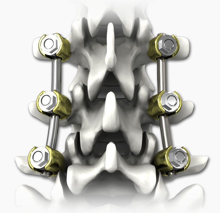 Thoraco-lumbar spinal osteosynthesis unit / posterior CONQUEST® Life Spine