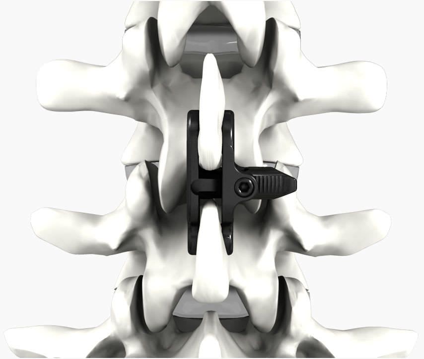 Interspinous vertebral implant AILERON® Life Spine