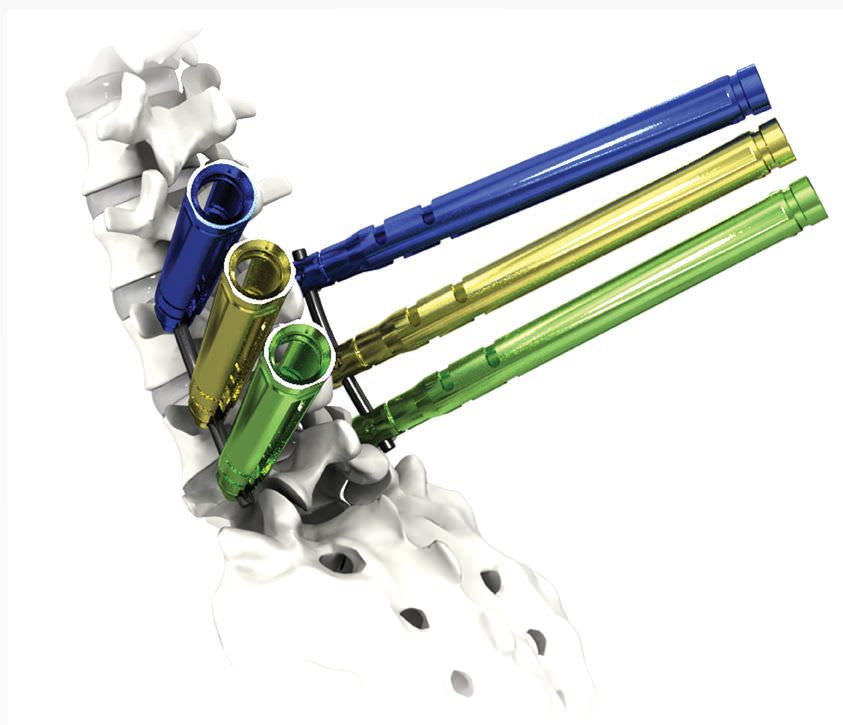 Thoraco-lumbar spinal osteosynthesis unit / posterior AVATAR® Life Spine