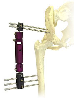 Human external fixation system / hip CROMUS BAUMER
