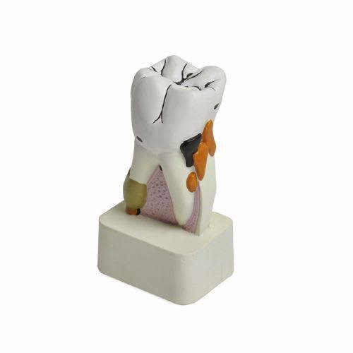 Tooth pathology anatomical model H130889 NetMed