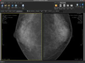 Diagnostic software / viewing / for mammography / medical Mammo PACSPLUS