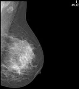 Analog mammography unit Giotto Analog IMS