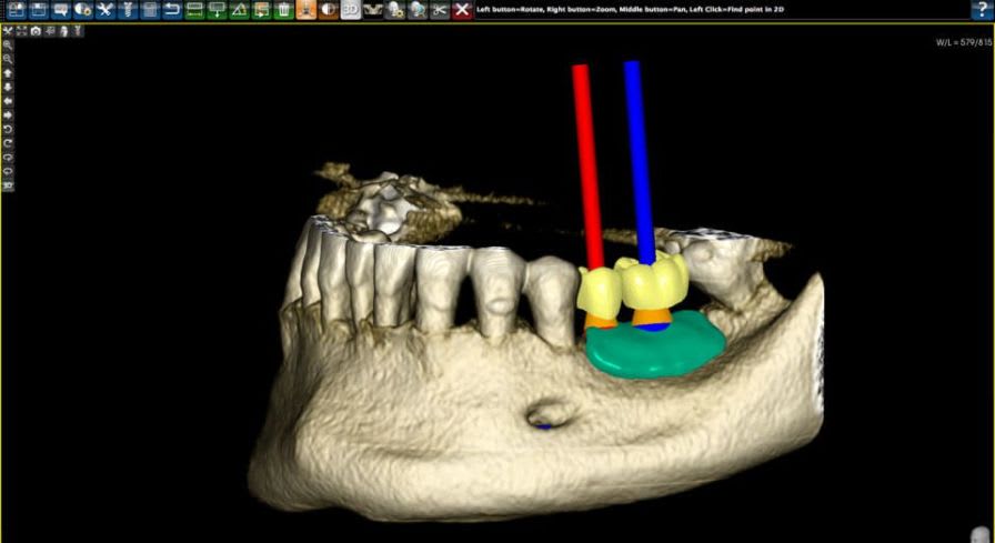 CAD software / for dental prosthesis design / medical PlastyCAD 3DIEMME