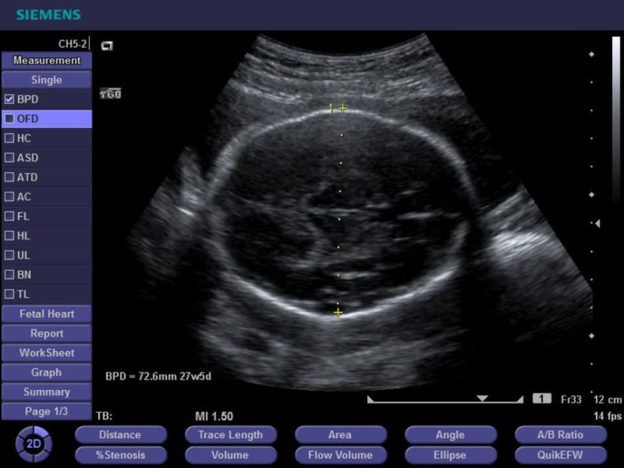 Ultrasound system / on platform / for multipurpose ultrasound imaging ACUSON X150 Siemens Healthcare