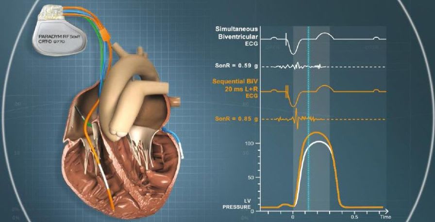Implantable cardiac stimulator / resynchronization / cardioverter-defibrillator / automatic Paradym™ RF SonR® CRT-D Sorin