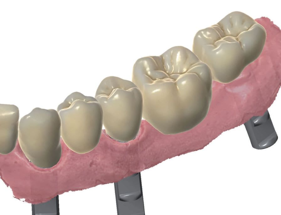 Dental prosthesis design software / CAD / CAM / dental laboratory SY0320 Zirkonzahn