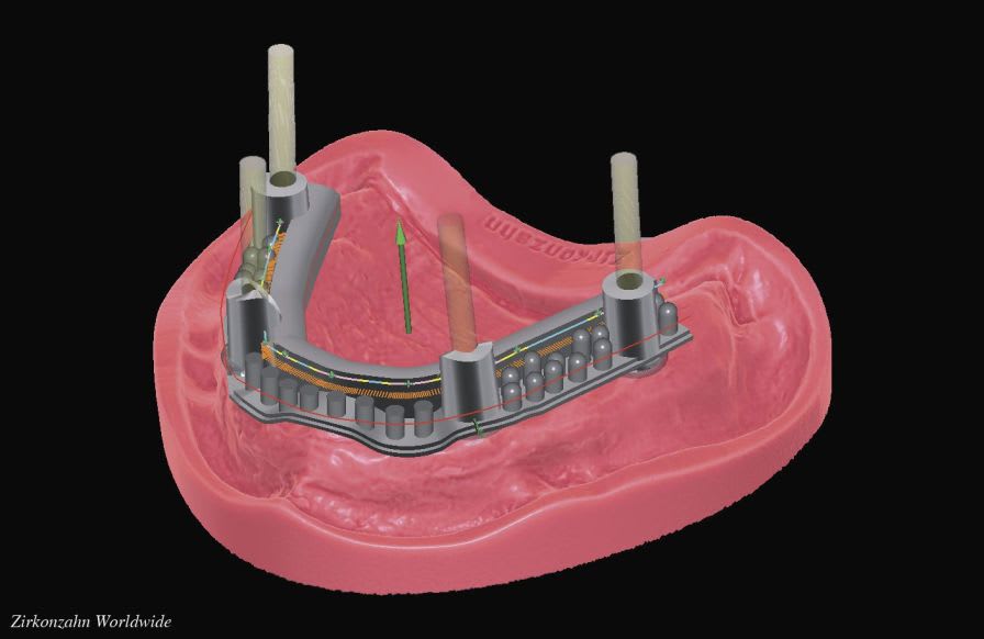 Dental prosthesis design software / CAD / CAM / dental laboratory Barres Zirkonzahn