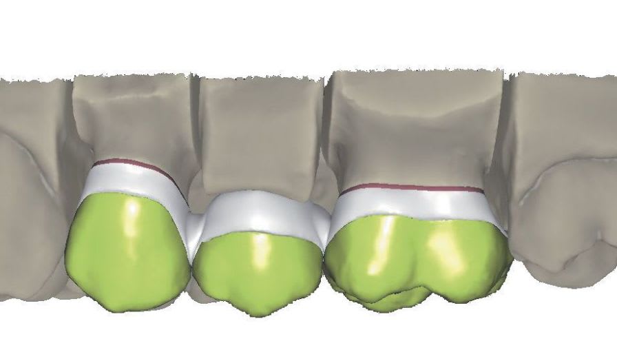 Dental prosthesis design software / CAM / CAD / dental laboratory SY0360 Zirkonzahn