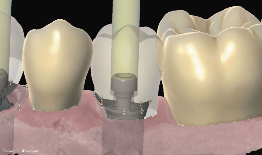 CAM software / CAD / for dental prosthesis design / 3D viewing SY0460 Zirkonzahn