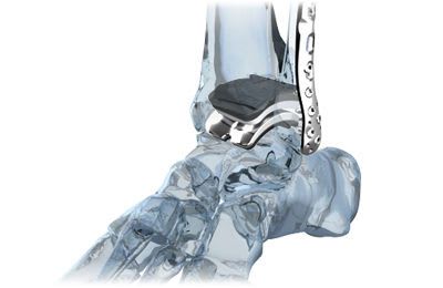 Total ankle prosthesis Zimmer® Trabecular Metal™ Zimmer
