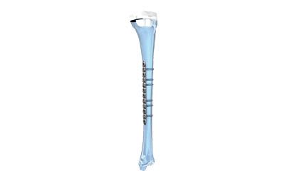 Tibia compression bone plate / medial NCB® Zimmer