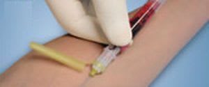 Blood donation needle S-Monovette® Sarstedt