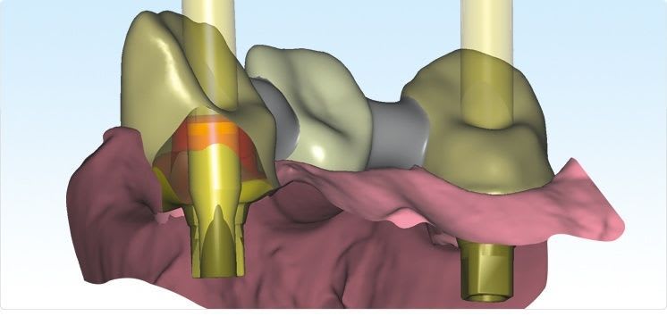 CAD software / for dental prosthesis design / medical Zfx
