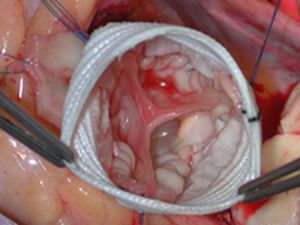 Aortic vascular prosthesis Gelweave Valsalva™ Vascutek