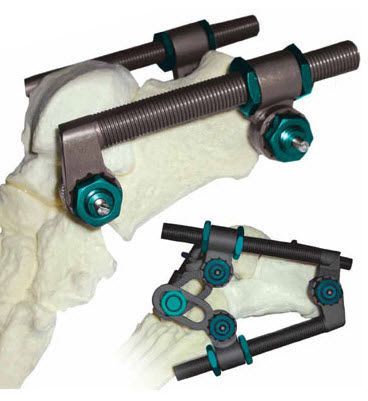 Human external fixation system / tarsal bones SIDEKICK® Wright Medical Technology