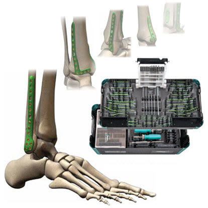Fibula compression bone plate / distal ORTHOLOC® 3DI Wright Medical Technology