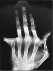 Metacarpophalangeal joint digit joint implant SWANSON Wright Medical Technology