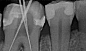 Dental radiography flat panel detector XIOS PLUS Sirona Dental Systems