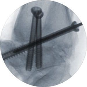 Not absorbable cannulated bone screw MaxTorque™ Tornier