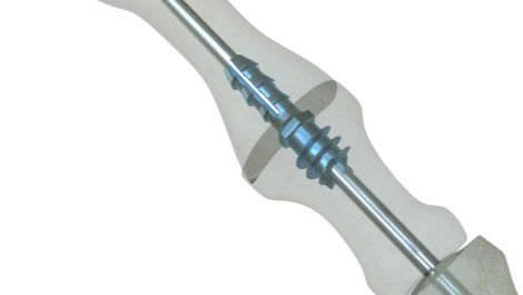 Interphalangeal foot joint arthrodesis cannulated bone screw / not absorbable CannuLink™ Tornier