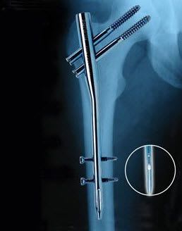 Human intramedullary nail / femur / proximal PROFIN TST R. Medical Devices