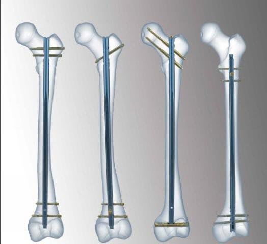 Human intramedullary nail / femur FIN TST R. Medical Devices