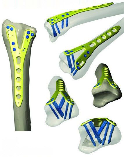 Radius compression bone plate / distal 60 - 99 mm TST R. Medical Devices