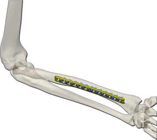 Ulna compression bone plate TST R. Medical Devices