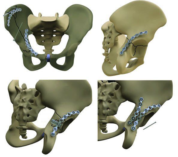 Acetabulum compression bone plate TST R. Medical Devices
