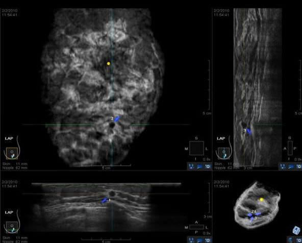 Ultrasound system / on platform / for breast ultrasound imaging somo?v ABUS INSIGHT U-Systems
