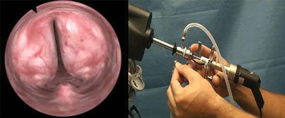 Transurethral resection of prostate training simulator VirtaMed TURPSim™ Simbionix