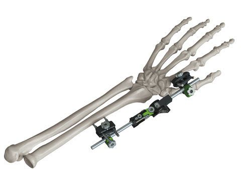 Human external fixation system / wrist GALAXY Orthofix