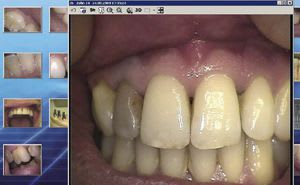 Digital video camera / intra-oral c-on nxt orangedental