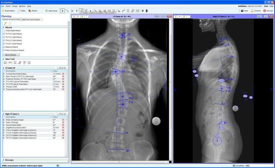 Management software module / planning / medical / orthopedic surgery Spinal OrthoView
