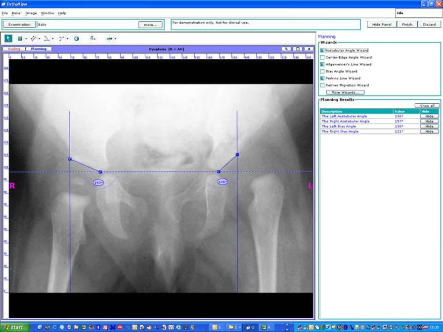 Preoperative planning software / orthopedic surgery / medical Joint Replacement OrthoView